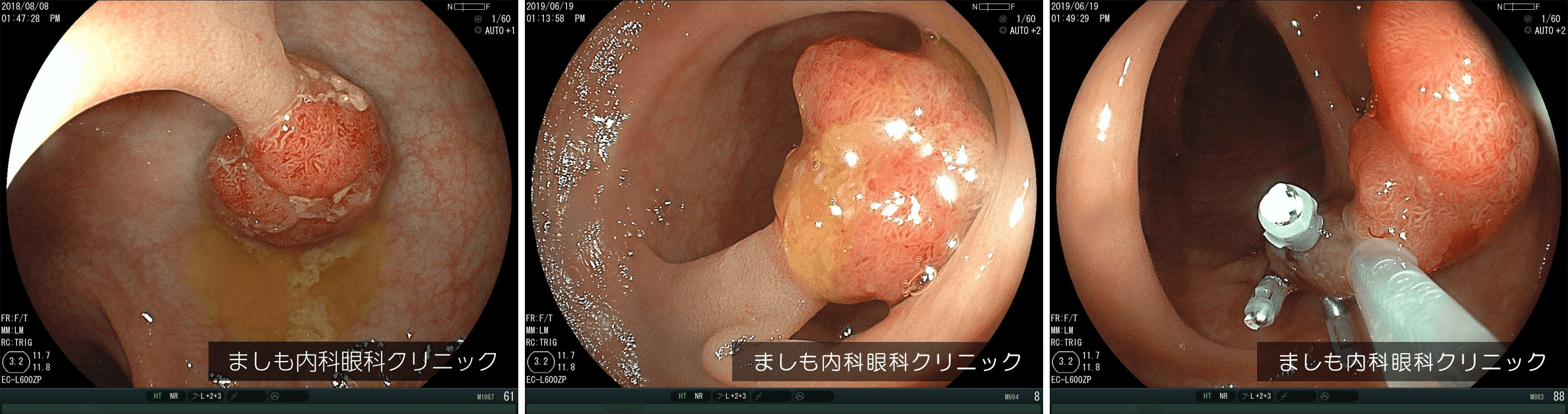 早期大腸がん