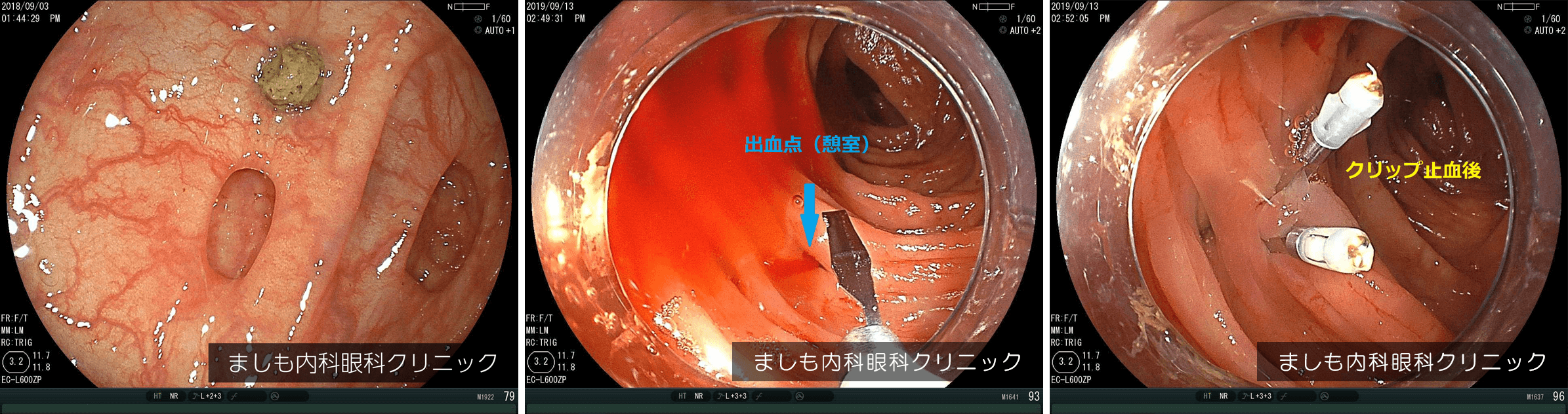 大腸憩室症