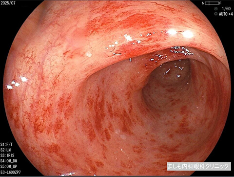 放射線性腸炎