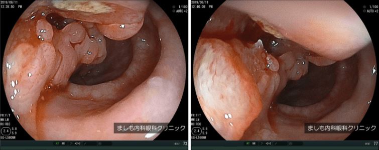 胃カメラでわかる病気 内視鏡 堺 ましも内科 眼科クリニック 胃カメラ 大腸カメラ