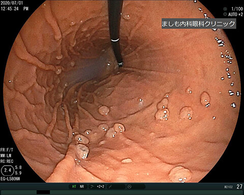 胃底腺ポリープ1