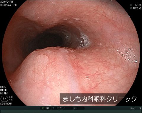 食道粘膜下腫瘍2