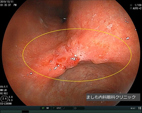 胃カメラでわかる病気 内視鏡 堺 ましも内科 眼科クリニック 胃カメラ 大腸カメラ