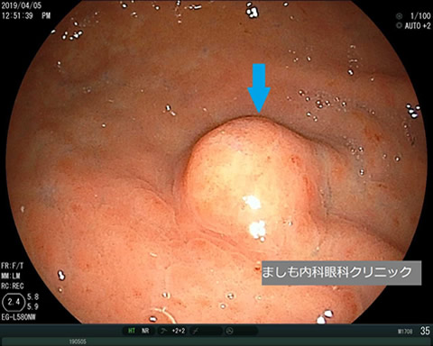 胃粘膜下腫瘍2