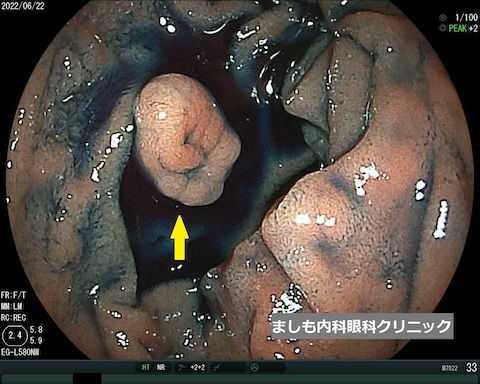 胃粘膜下腫瘍1