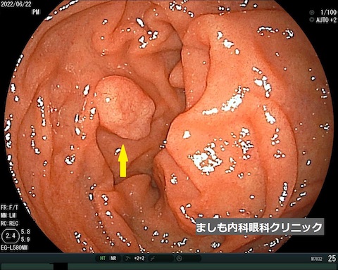 胃粘膜下腫瘍2