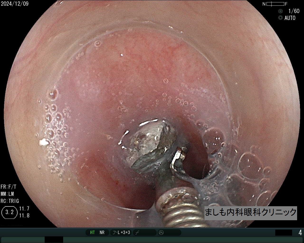 胃異物回収2