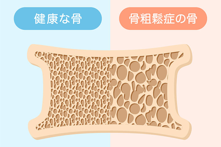 骨粗しょう症