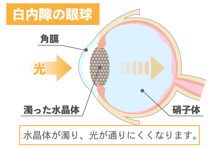 白内障