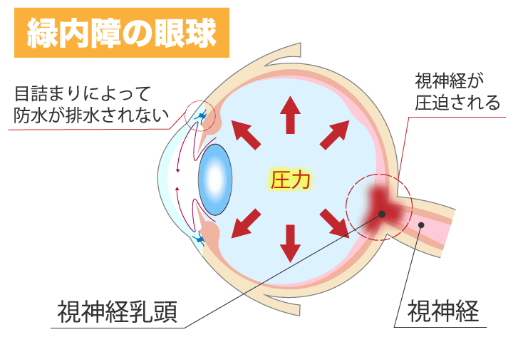 緑内障