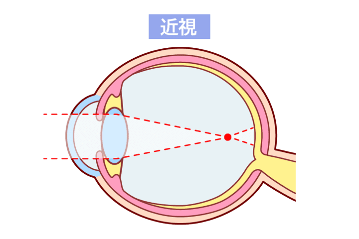 近視