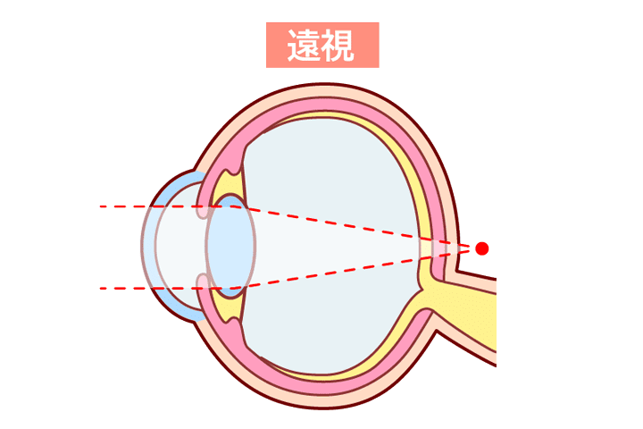 遠視